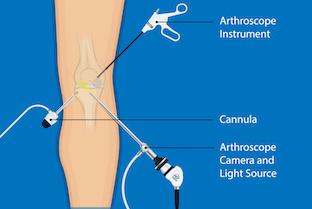 Arthroscopy Diagram