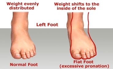 flat foot treatment in hindi